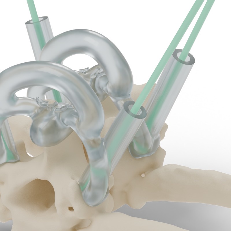 Close-up of the frosted resin guide with drill sleeves and green trajectory pins