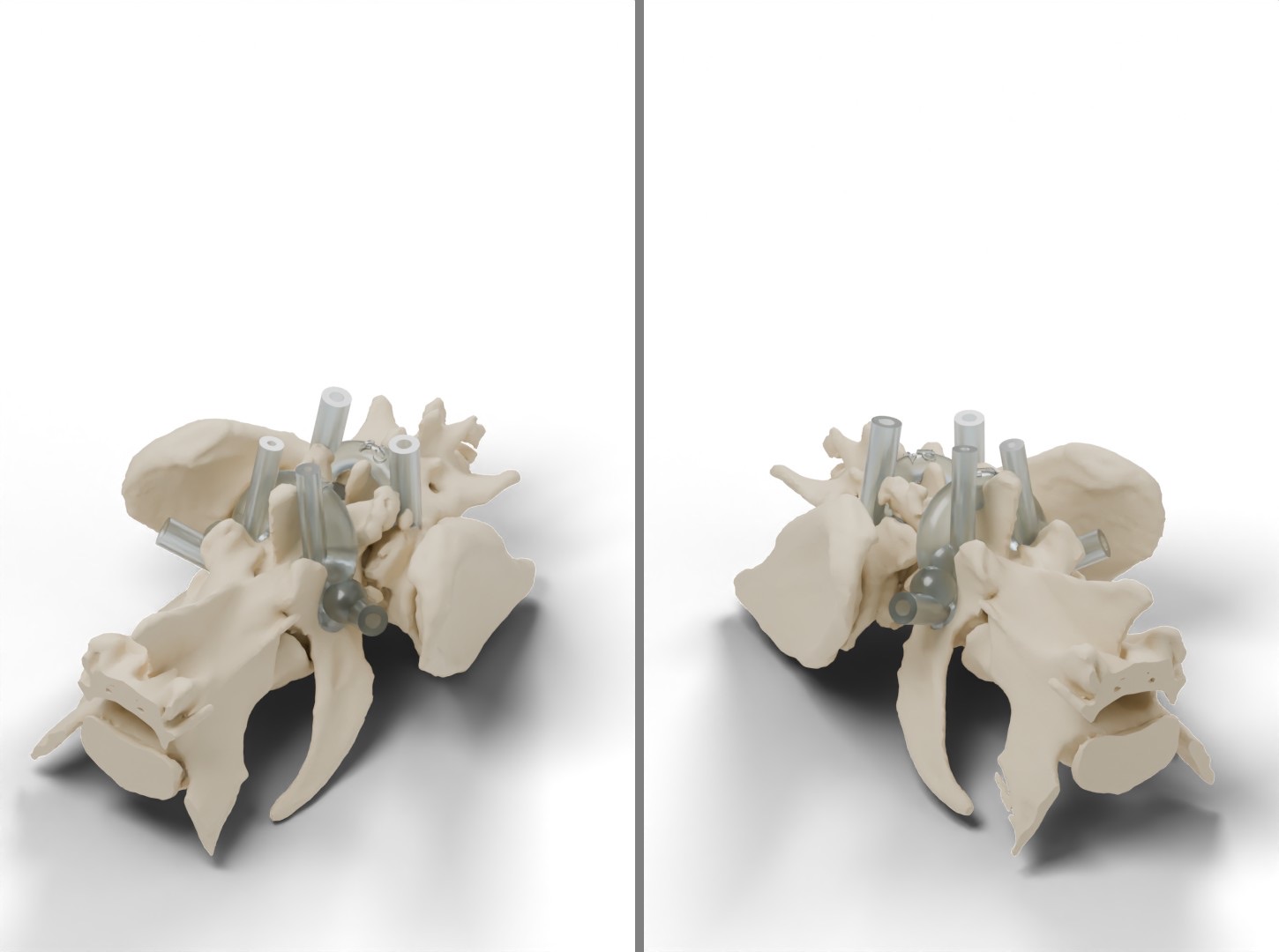 Two views of a lumbosacral case with L7 and S1 drill guides seated on the bone