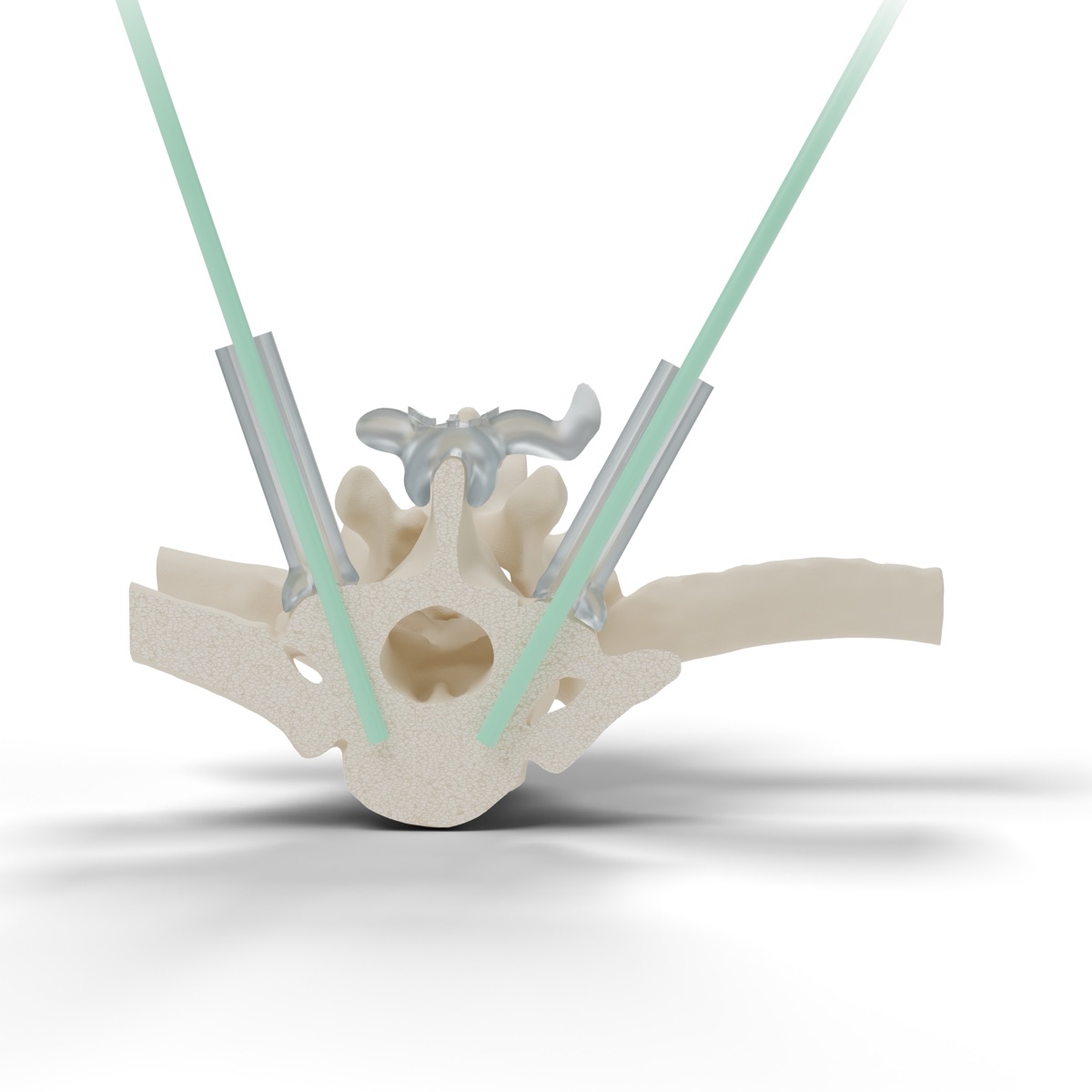 Transverse section of a vertebra showing two planned screw trajectories passing through the pedicles, with the guide sleeves above